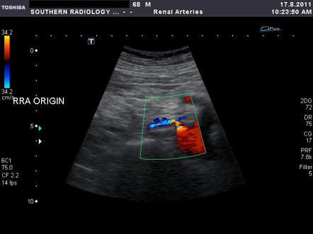 USG de artéria renal apresentando fluxo turbulento e aumento da velocidade de fluxo na artéria renal em relação à aorta. Sugestivo de estenose de artéria renal. Fonte: Radiopaedia (https://radiopaedia.org/images/1332430?case_id=14760)