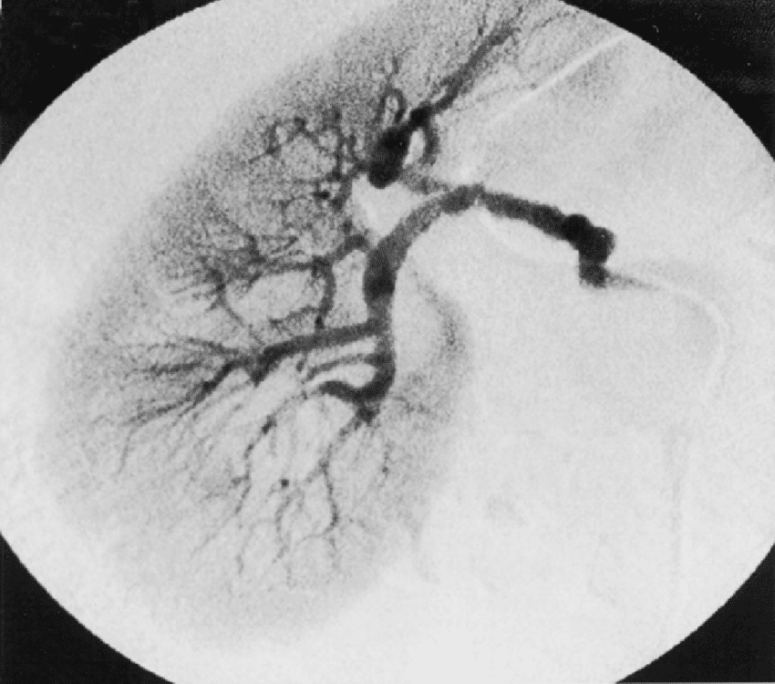 Arteriografia renal direta mostrando artéria em “contas de colar”. Achado típico de displasia fibromuscular. Fonte: ResearchGate (https://www.researchgate.net/figure/Figura-10-Angiografia-renal-direita-mostrando-arteria-em-contas-de-colar-tipico-de_fig6_265537245)