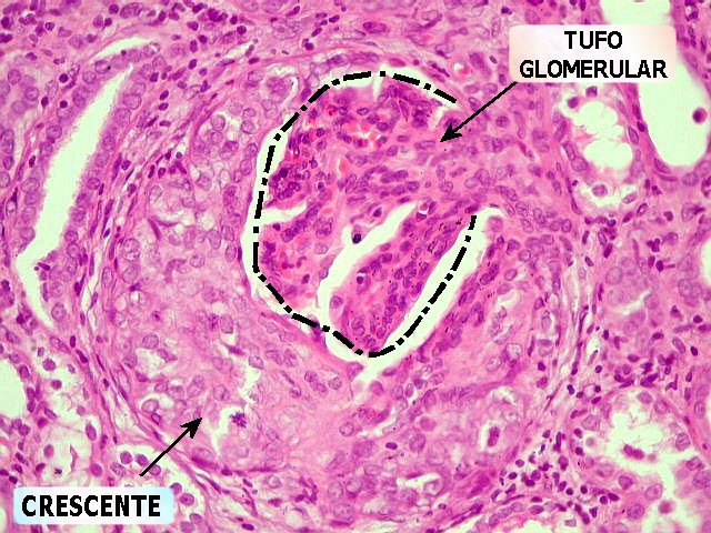 Lâmina histológica com crescentes epiteliais. Os crescentes são proliferações de células no folheto parietal da cápsula de Bowman, estimuladas pela deposição de fibrina. Fonte: Anatpat (http://anatpat.unicamp.br/lamuro3.html)