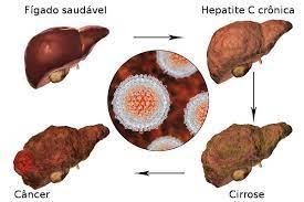 Fonte: Mundo Educação (https://mundoeducacao.uol.com.br/doencas/hepatite-c.htm)