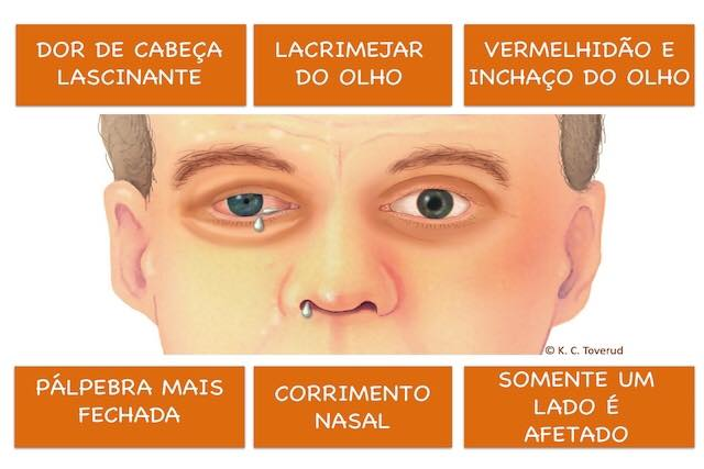 Apresentação típica do paciente com CTA. Fonte: Liga Acadêmica de Clínica Médica do Agreste