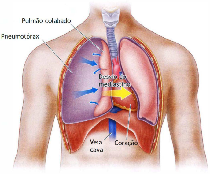 Representação do pneumotórax hipertensivo. Fonte: ATLS – Advanced Trauma Life Support for Doctors. 10. ed, 2018.