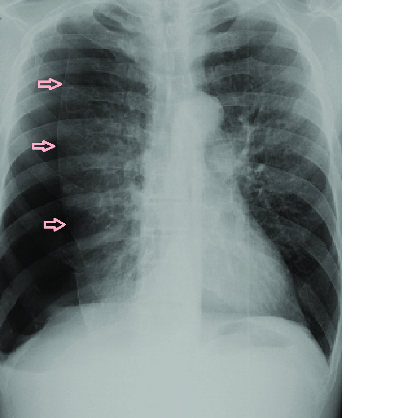 Raio-X de pneumotórax hipertensivo. Fonte: ResearchGate
