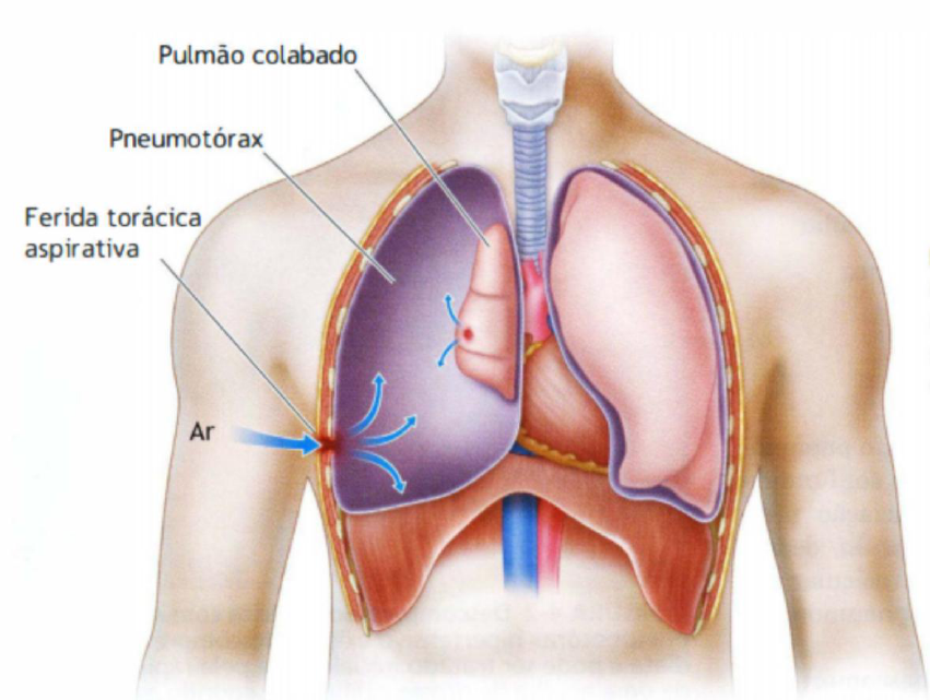 Representação do pneumotórax aberto. Fonte: ATLS – Advanced Trauma Life Support for Doctors. 10. ed, 2018.