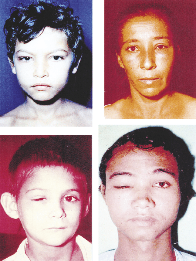 Pacientes com graus variados do sinal de Romaña: edema bipalpebral unilateral por reação inflamatória à penetração do parasita na conjuntiva e adjacências. Ocorre devido a reação inflamatória pela penetração do parasita. Fonte: (https://www.researchgate.net/figure/Figura-7-Exemplos-de-sinal-de-Romana-com-graus-variaveis-de-edema-palpebral_fig2_269985225)