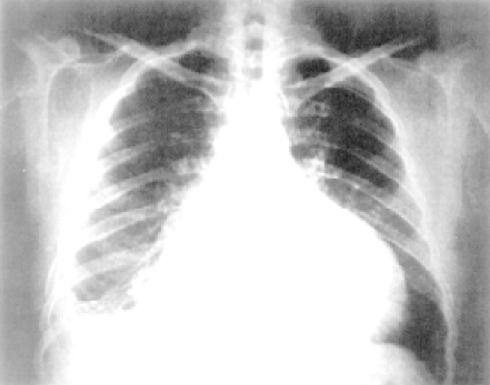 Raio-X de paciente com doença de Chagas evidenciando miocardiopatia dilatada e derrame pleural à direita. Fonte: https://www.scielo.br/j/rsbmt/a/5gYW3L5M83grL9HmTGSNnsN/?lang=pt