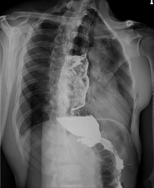 Em caso de suspeita de megaesófago chagásico, realiza-se a radiografia com bário para observar a progressão do contraste, bem como observar distúrbios de motilidade característicos da doença. Esofagograma evidenciando paredes tortuosas, dilatadas e dificuldade de progressão do contraste. Fonte: https://radiopaedia.org/cases/chagas-disease-megaoesophagus?lang=us