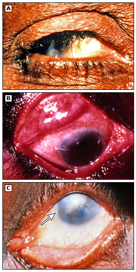 Imagem A: corresponde a triquíase tracomatosa. Imagem B: corresponde ao pannus, que surge devido a reação inflamatória provocada pelos cílios em contato com a córnea. Imagem C: demonstra a opacidade da córnea. Fonte: UpToDate
