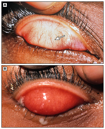 Imagem A: demonstra conjuntiva tarsal superior normal. Imagem B: mostra o tracoma intenso, com achado de hipertrofia papilar e espessamento da conjuntiva devido a reação inflamatória. Fonte: UpToDate