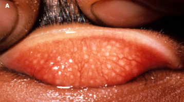 Tracoma inflamatório folicular. Fonte: https://www.uptodate.com/contents/image?imageKey=ID%2F73800&topicKey=ID%2F3026&search=trachoma&rank=1~20&source=see_link