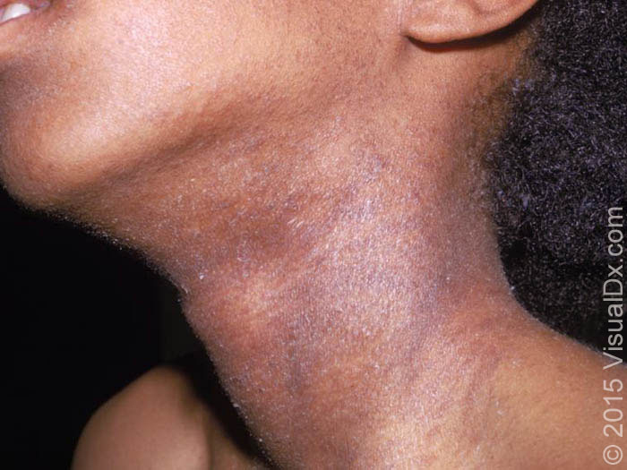 Paciente com lesões da dermatite atópica no pescoço. Fonte: UpToDate
