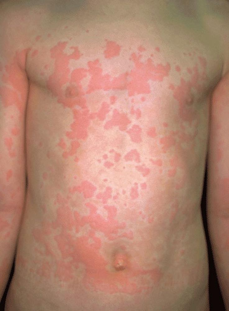 Eritema urticariforme. Fonte: MSD Manuals (https://www.msdmanuals.com/pt-pt/profissional/dist%C3%BArbios-dermatol%C3%B3gicos/abordagem-ao-paciente-dermatol%C3%B3gico/urtic%C3%A1ria)