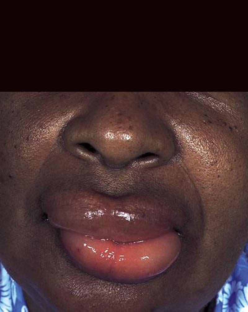 Edema de lábios. Fonte: MSD Manuals
