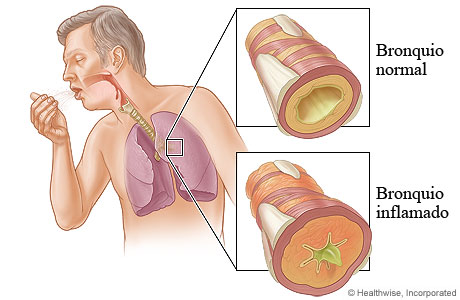 A constrição dos brônquios, devido ao processo inflamatório, é responsável por provocar os sintomas típicos de acometimento de vias aéreas inferiores, como o sibilo. Fonte: https://multipress.com.mx/noticias/broncodilatacion-epoc/