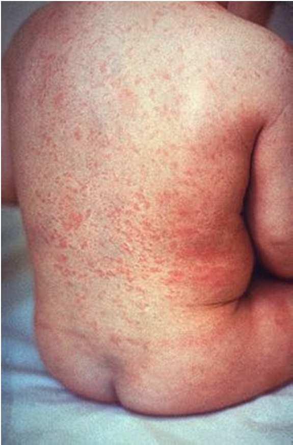 Exantema maculopapular e puntiforme difuso