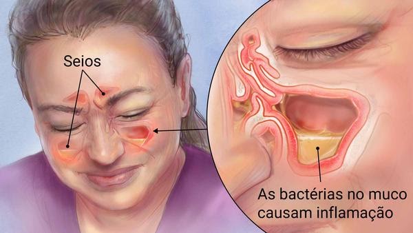 Inflamação dos seios nasais pode causar obstrução nasal