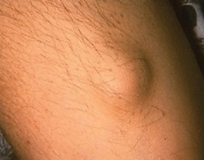 Os nódulos subcutâneos na febre reumática são indolores e variam de 0,5 a 2 cm