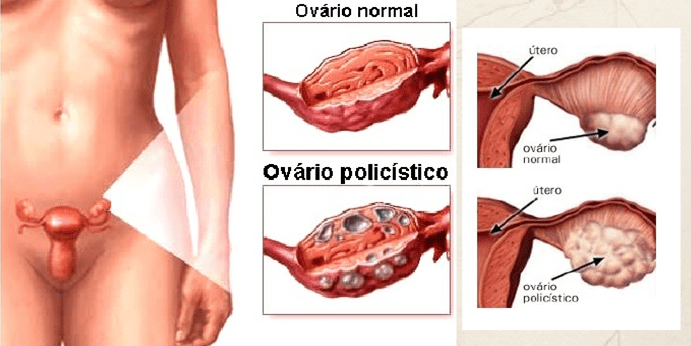 Representação da micropolicistose na SOP. Fonte: https://www.fivmed.com.br/blog/sindrome-dos-ovarios-policisticos-sop-e-infertilidade/