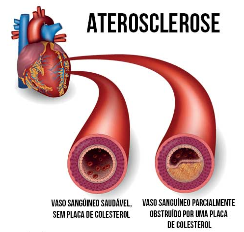 Ilustração da placa de ateroma. Fonte: Clínica Azzi