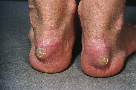 Xantoma tendinoso. Fonte: DermatoPatologia