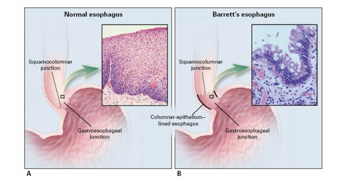 Comparação do epitélio normal esofágico (escamoso) com a metaplasia do esôfago de Barrett (células colunares). Fonte: https://www.lume.ufrgs.br/bitstream/handle/10183/7332/000542261.pdf?sequence=1