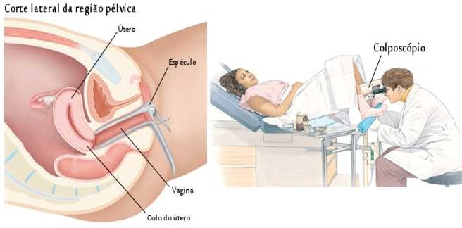 Representação da realização da colposcopia. Fonte: https://hpvonline.com.br/sobre-hpv/hpv-e-diagnostico/colposcopia-e-papanicolaou-e-a-biopsia-do-colo-uterino/