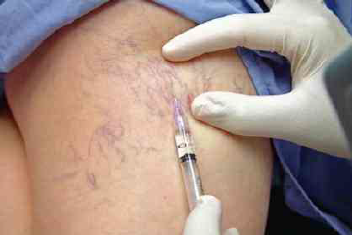 Injeção líquida para escleroterapia. Fonte: Cirurgia Vascular Rutherford