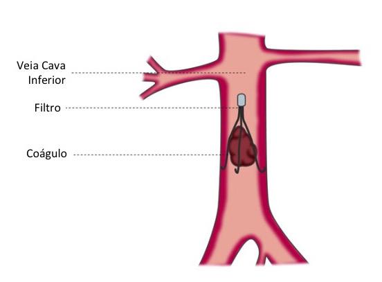 Filtro de Veia Cava impedindo passagem do êmbolo e consequentemente a evolução para TEP Fonte: https://www.dranayarabatagini.com.br/tratamentos/trombose-venosa-profunda/filtro-de-veia-cava/