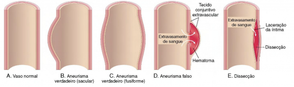 Tipos de aneurisma. Fonte: Patologia Robbins