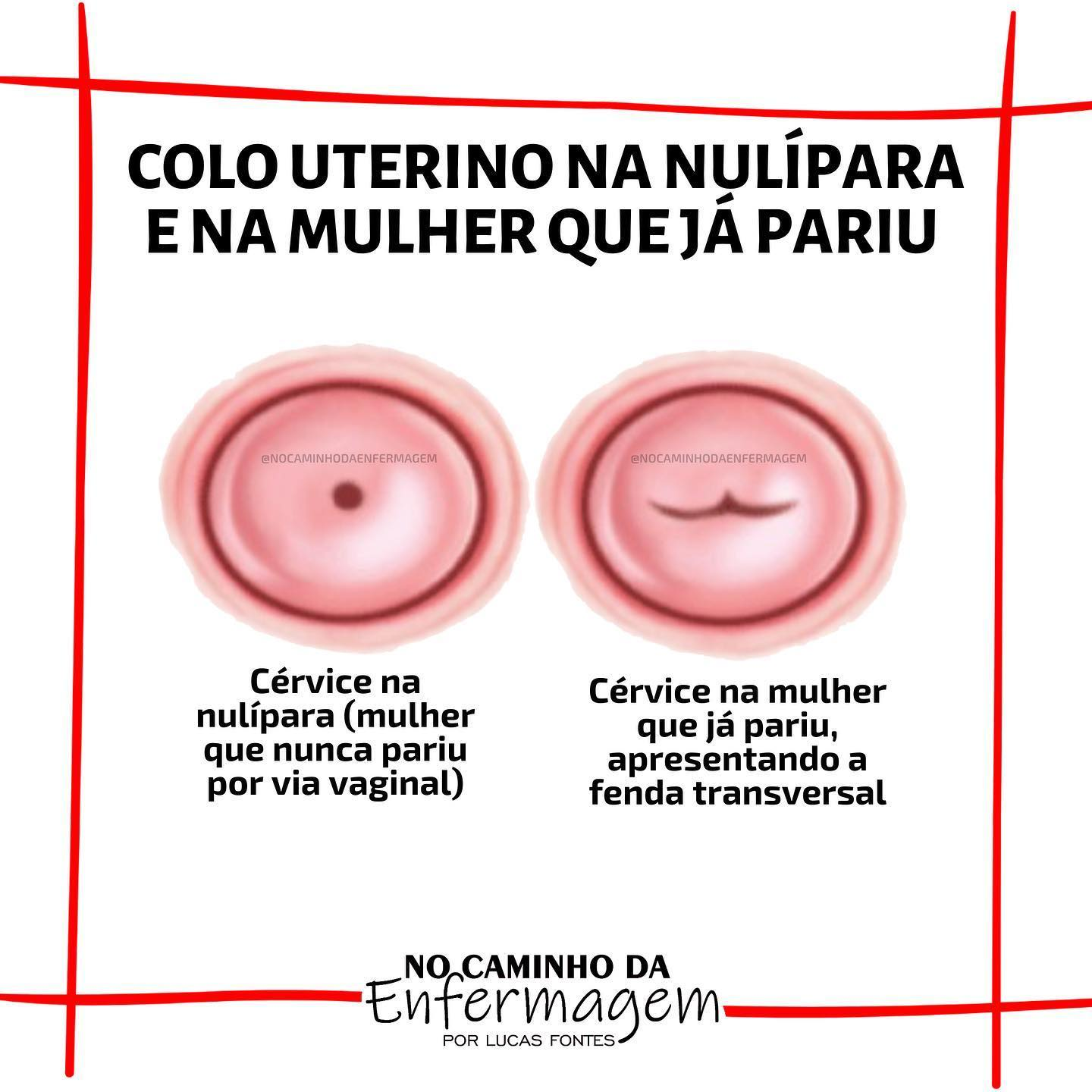 Aspecto do colo puntiforme versus em fenda. Fonte: No Caminho da Enfermagem