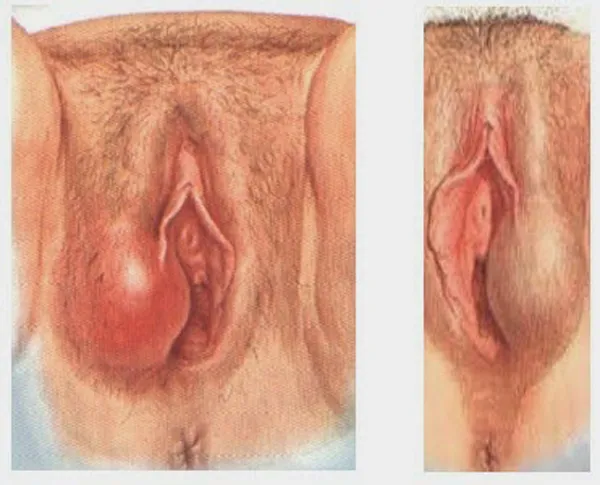 Representação da bartolinite, inflamação das glândulas de Bartholin. Fonte: https://saude.umcomo.com.br/artigo/como-tratar-a-bartolinite-sintomas-causas-e-remedios-naturais-23989.html