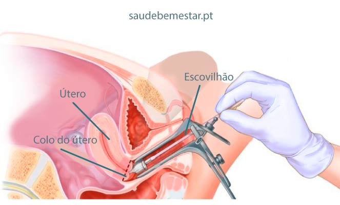 Representação do exame preventivo. Fonte: https://www.saudebemestar.pt/pt/clinica/ginecologia/papanicolau/