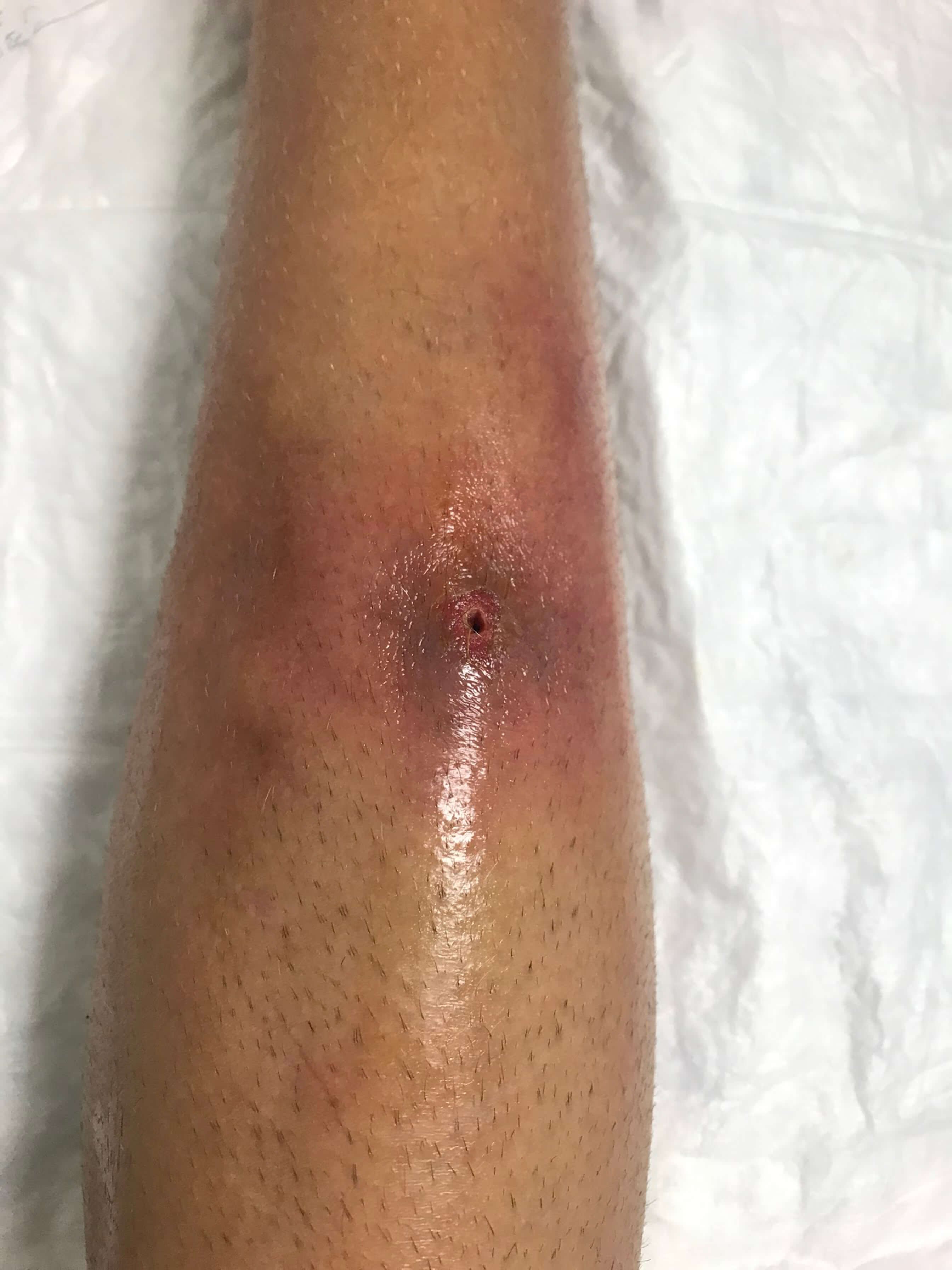 Infección en la tibia por estafilococo