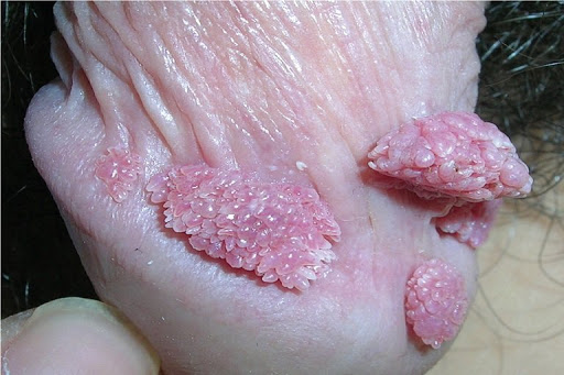 Bệnh sùi mào gà ở nam giới là gì và mức độ ảnh hưởng