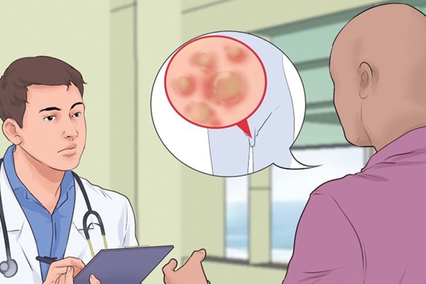Các phương pháp điều trị bệnh sùi mào gà ở nam giới