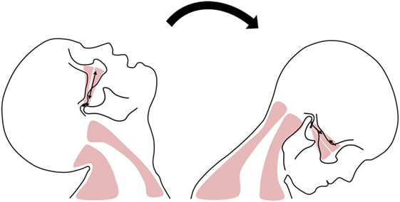 Diagrama de latigazo cervical