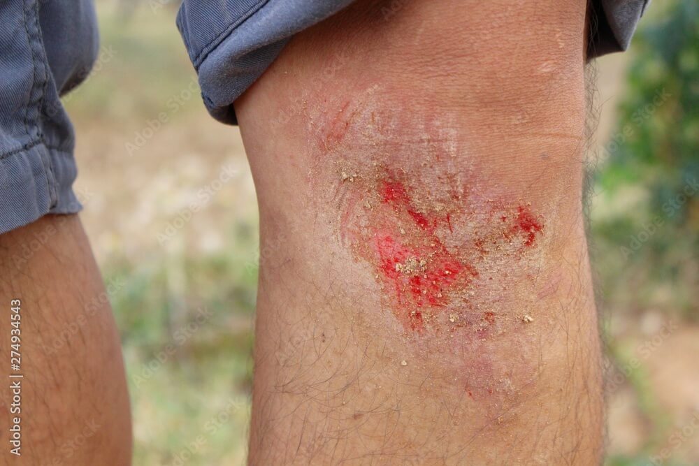 Primer plano de un sarpullido en la rodilla. 
