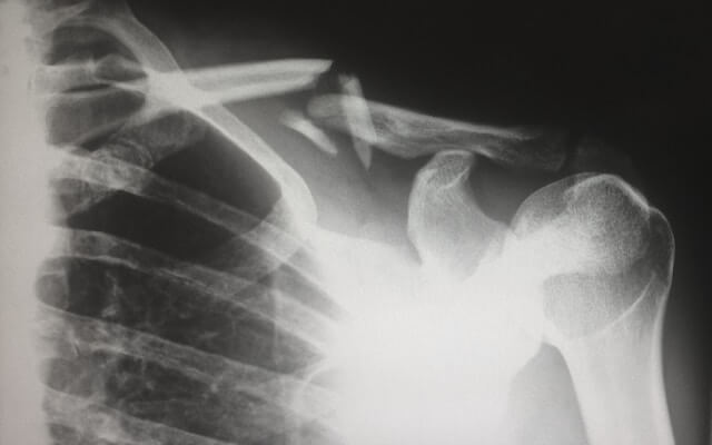 Radiografía de un hombro roto