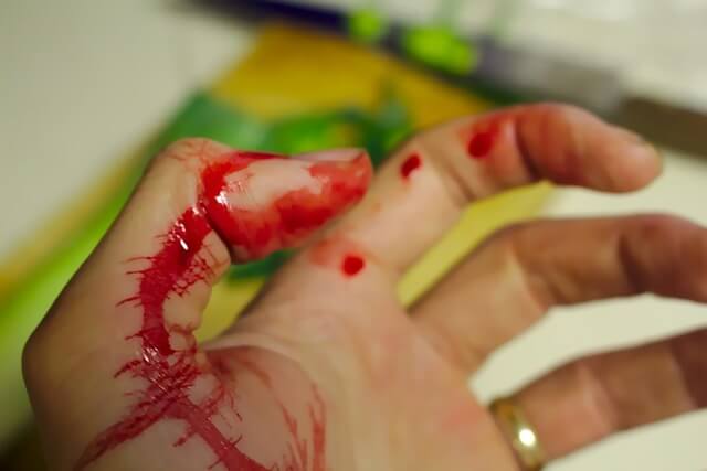 Mano de mujer sangrando por herida. 