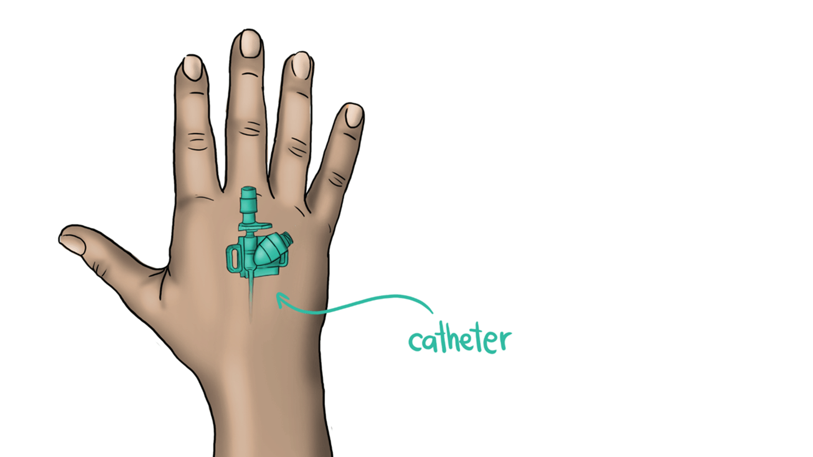 INTRAVENOUS CATHETER Bioana