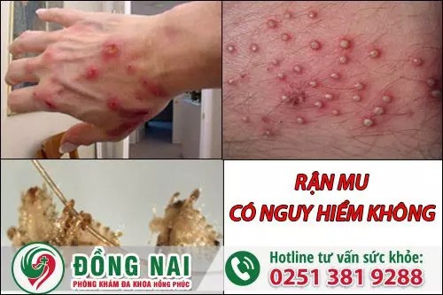 Triệu chứng khi mắc bệnh rận mu