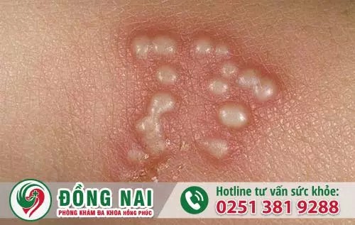 Tóm tắt bệnh mụn rộp sinh dục