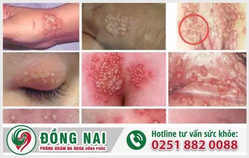 Triệu chứng bệnh mụn rộp sinh dục