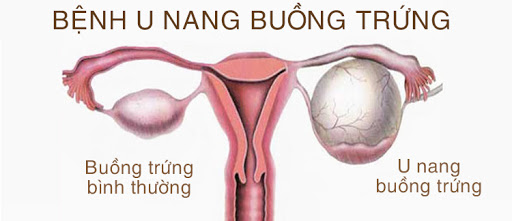 Bệnh u nang buồng trứng