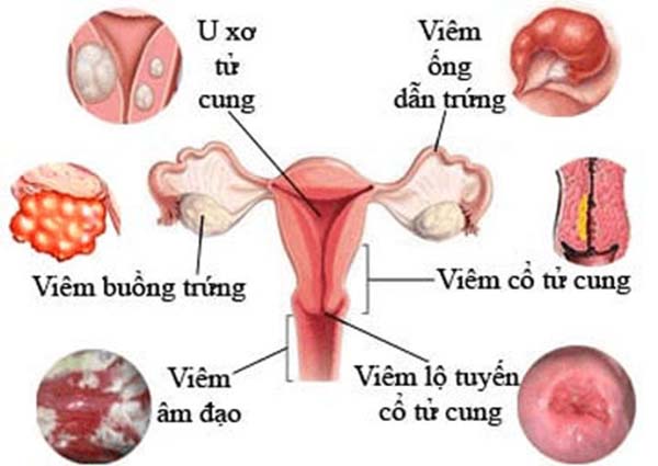 bệnh phụ khoa