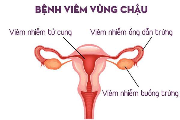 viêm vùng chậu