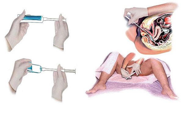 Cách đặt thuốc phụ khoa tại nhà