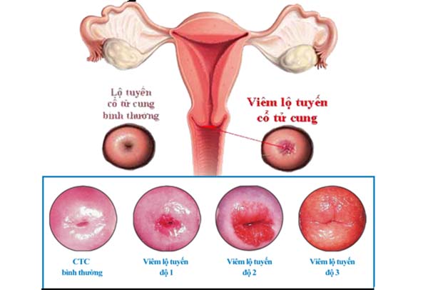 các cấp độ viêm lộ tuyến