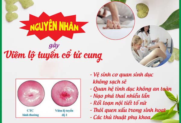 Nguyên nhân gây viêm lộ tuyến