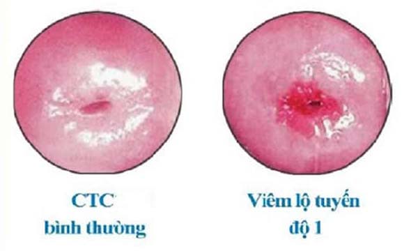 Hình ảnh viêm lộ tuyến độ 1